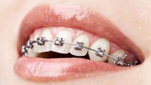 Teeth Alignment Treatment