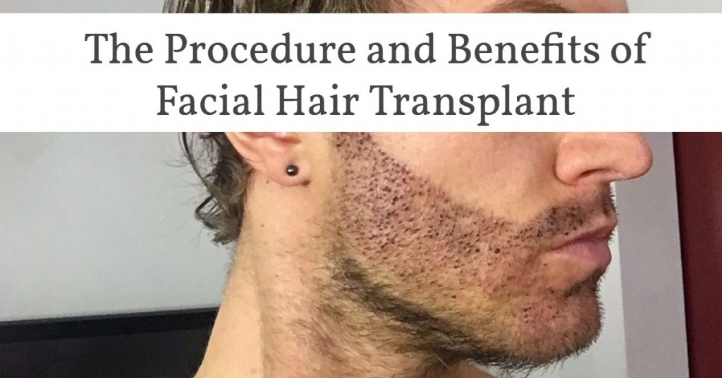 facial hair transplant- The procedure and benefits of facial hair transplant