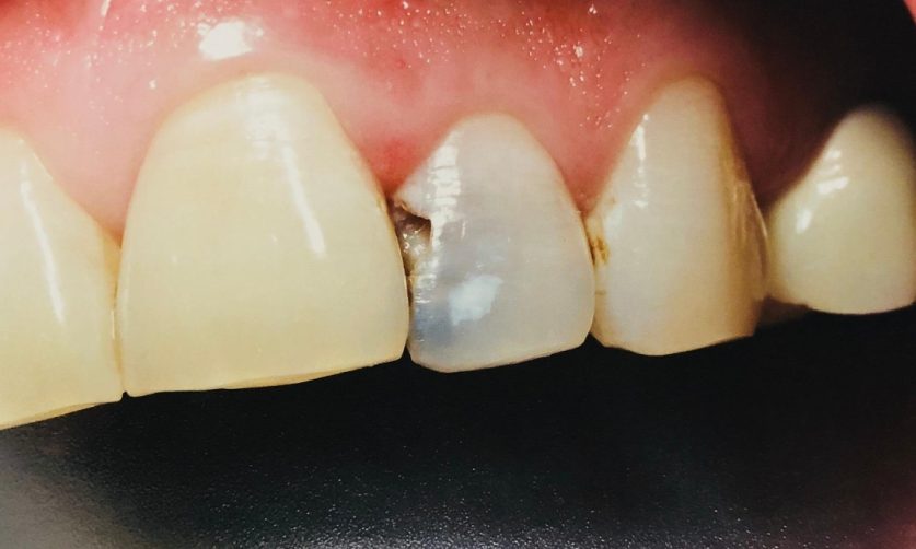cavity on front toot