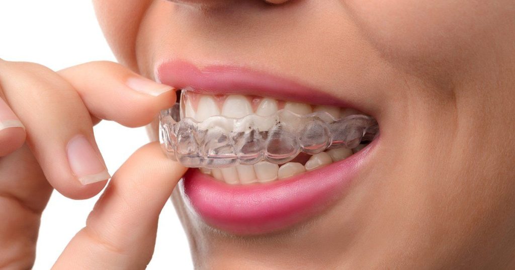 Invisalign Clear Aligners