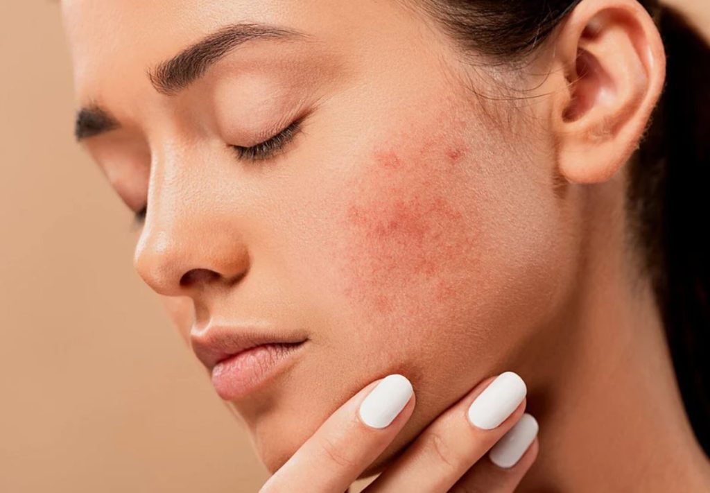 acne scars