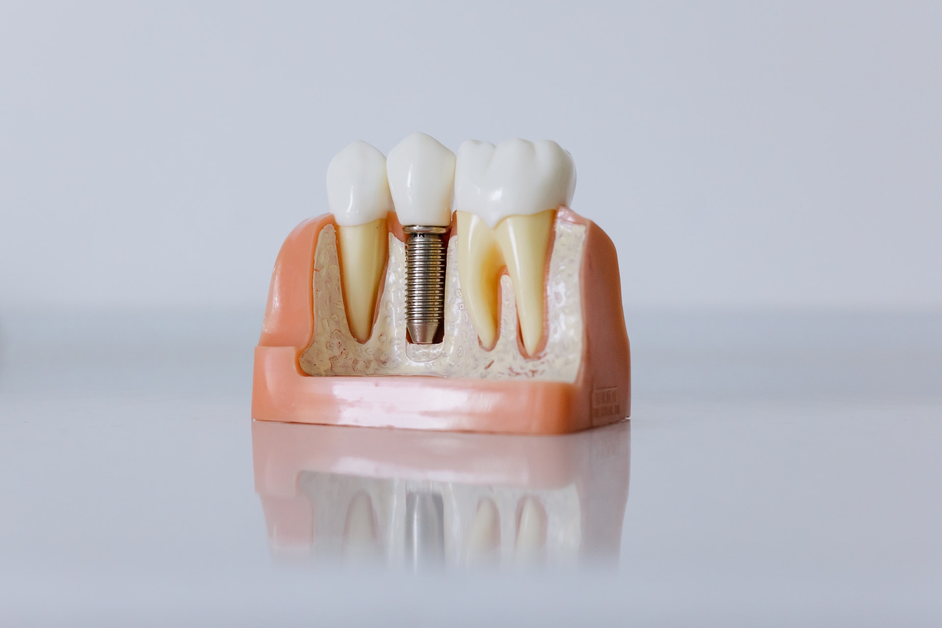 Dental Implants London Ontario