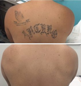 Before and after laser tattoo Removal