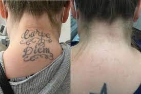 Before and after laser tattoo Removal